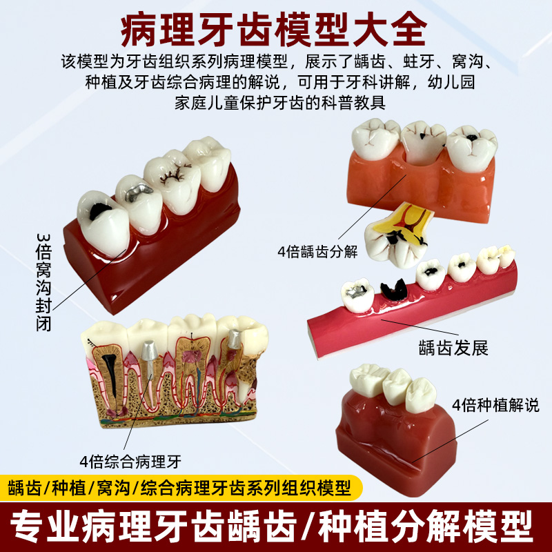 牙齿模型坏牙科种植六倍大
